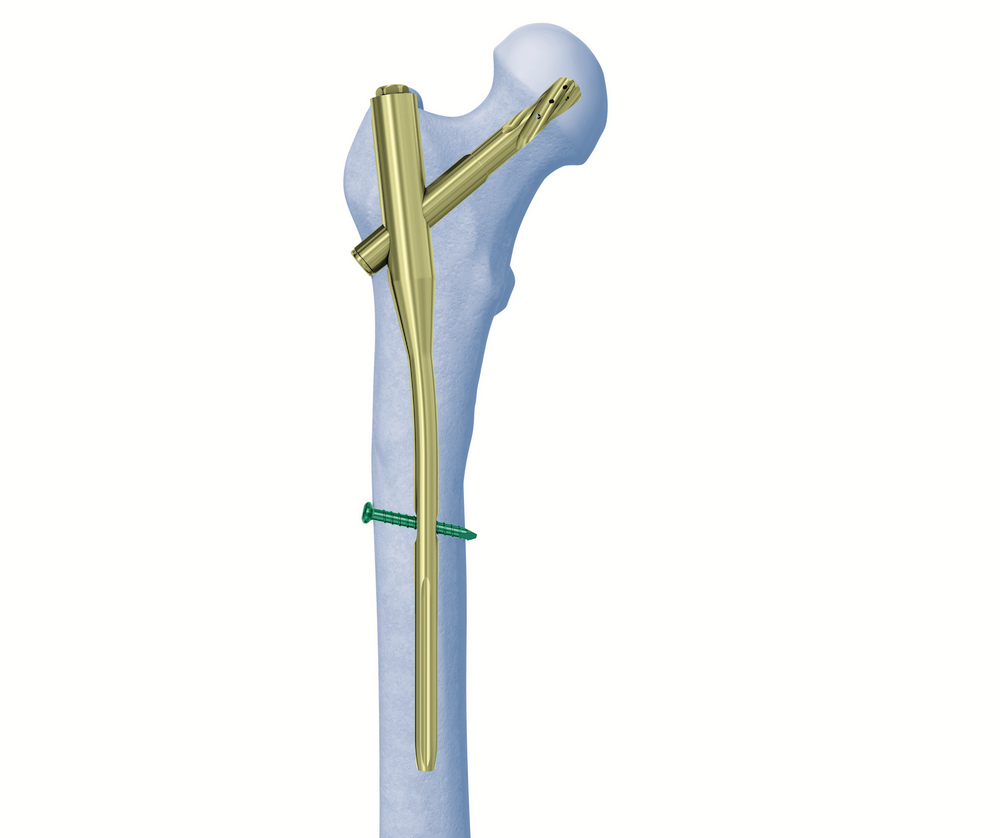 Customised proximal femoral nail in treatment of intertrochanteric fracture  with ipsilateral femoral shaft malunion: A case report. - Abstract - Europe  PMC